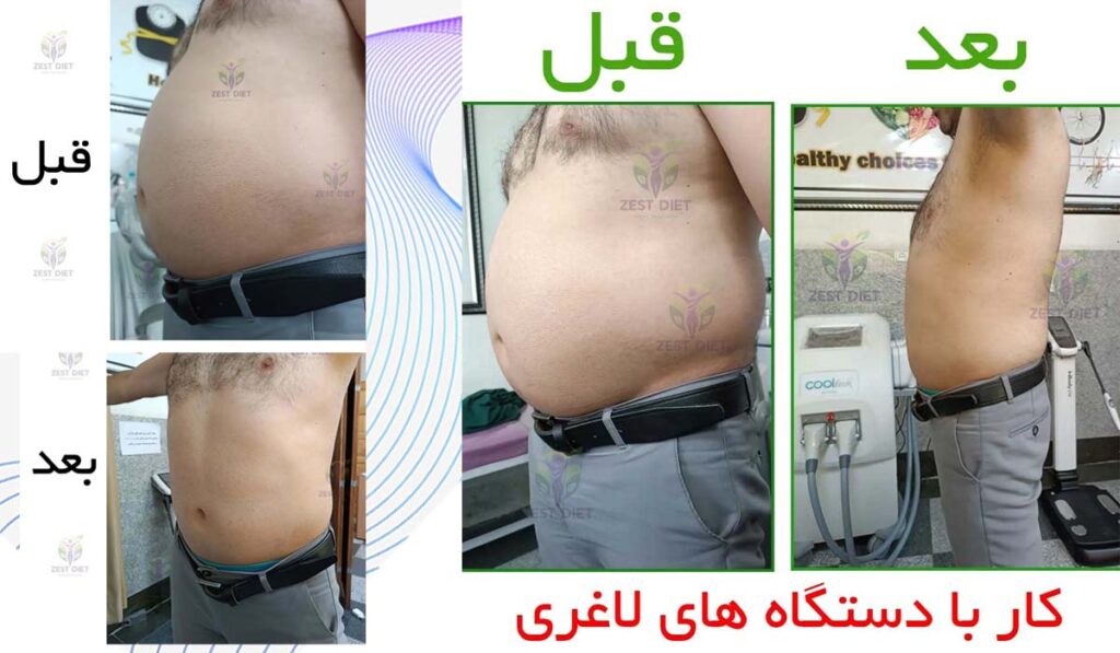 نمونه لاغری شکم با دستگاه لاغری