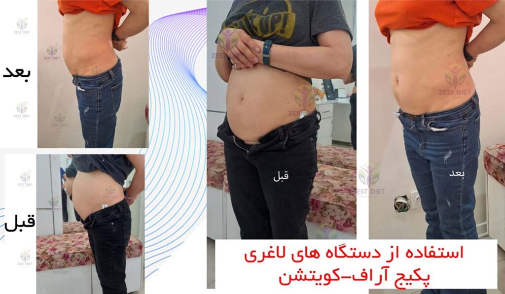 نمونه کار لاغری با دستگاه در شرق تهران