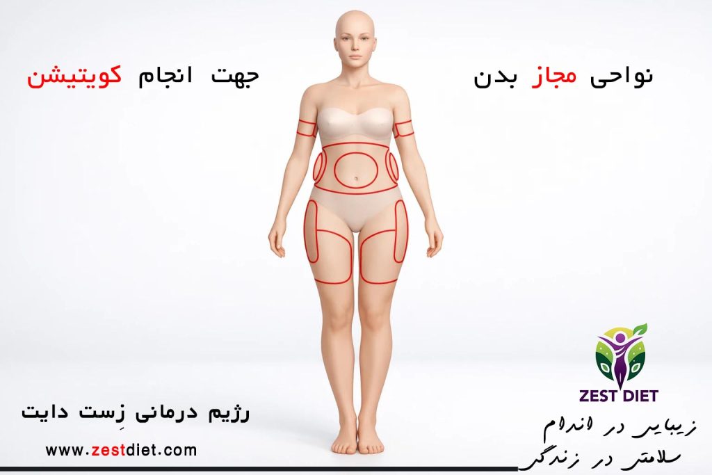 نواحی مجاز بدن برای انجام کویتیشن (شکم، پهلو، ران و بازو) در کلینیک شرق تهران

