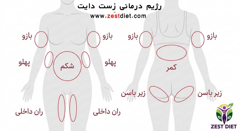 نقاط مناسب برای لاغری موضعی با کرایولیپولیز در زنان و مردان